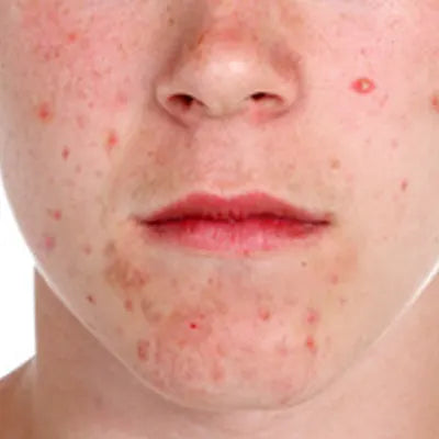 Perioral (Facial Contact) Dermatitis
