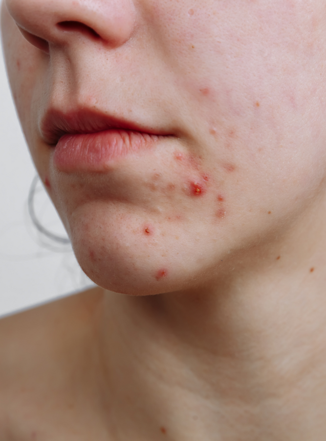 The Risks and Ineffectiveness of Egg White Facial Masks