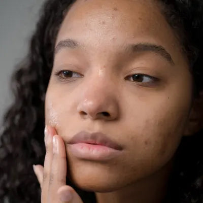 Acne Prone Skin