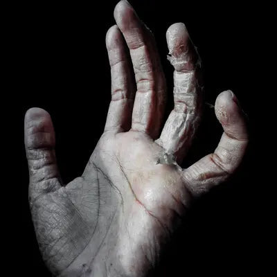 Contact & Atopic Dermatitis (Eczema)